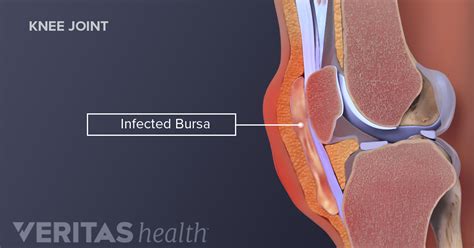 Septic Bursitis | Arthritis-Health