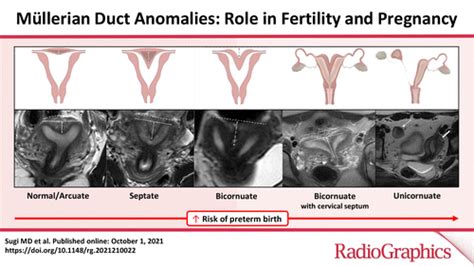 Müllerian Duct Anomalies: Role in Fertility and Pregnancy | RadioGraphics