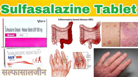 Sulfasalazine tablet uses,dose,side-effects | Saaz tablet use | Saro ...