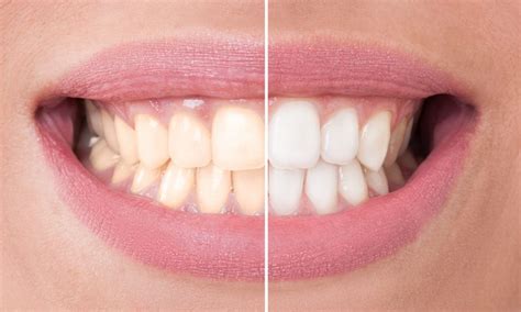 Before and after bleaching - Special Offers Edinburgh | Teeth Whitening | Invisalign Edinburgh