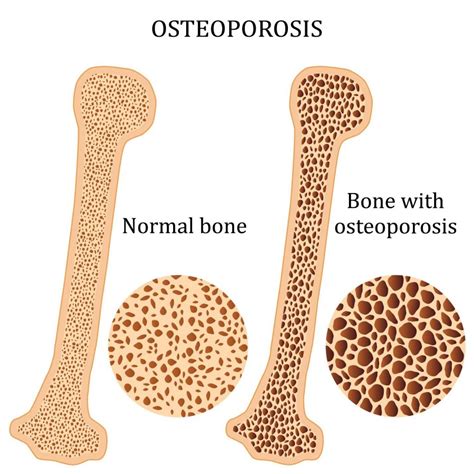 A Natural Approach to Osteoporosis and Bone Health | Alternativedrmcare