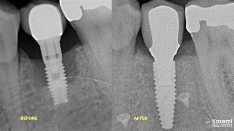 Peri-implantitis bone loss dental implant bone graft kazemi oral ...