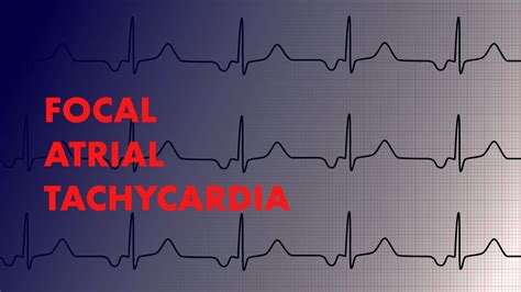 Focal Atrial Tachycardia - EKG Interpretation - MEDZCOOL - YouTube