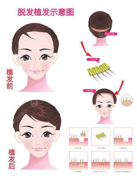 Hair Transplant Vector Hd PNG Images, Schematic Diagram Of Beauty Hair Loss And Hair ...