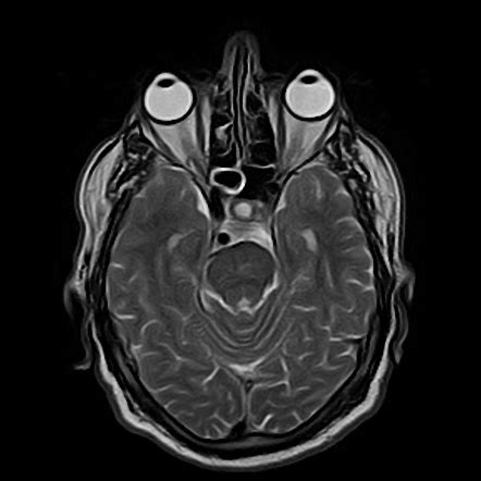 Vertebrobasilar dolichoectasia | Radiology Case | Radiopaedia.org