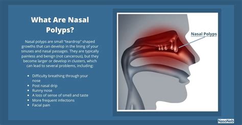 Nasal Polyps: Causes, Symptoms, Treatments, and Prevention