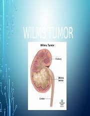 Understanding Wilms Tumor: Symptoms, Stages, and Treatment | Course Hero