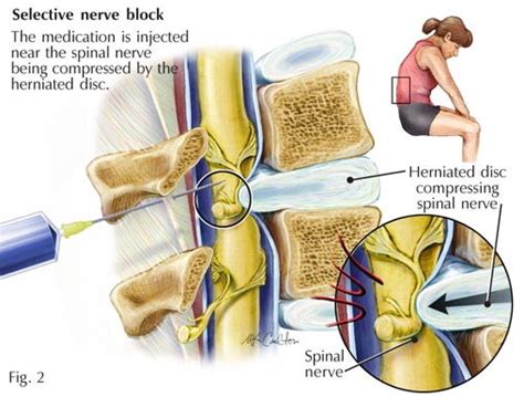 Selective Nerve Root Block — Pawleys island pain management