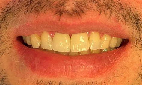 Limited Smile Makeover - Replacing Defective Bonding with Porcelain Crowns Before & After Photos ...