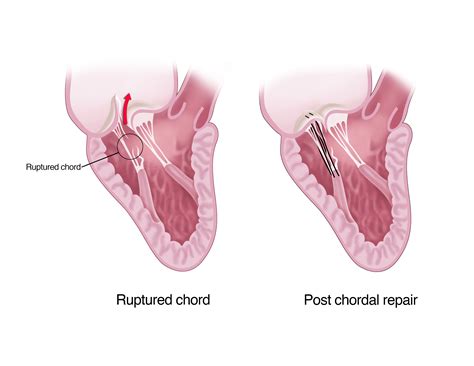 Mitral Valve Regurgitation Symptoms and Replacement | UPMC