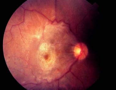 Epiretinal Membrane: Background, Pathophysiology, Epidemiology