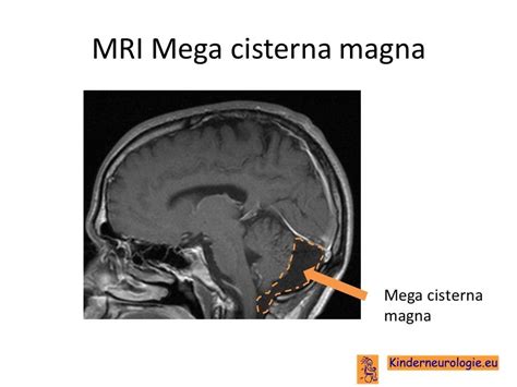 Cisterna Magna