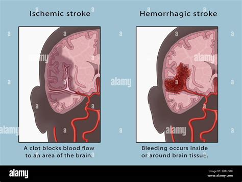 Hemorrhagic Stroke High Resolution Stock Photography and Images - Alamy