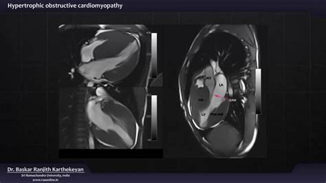 Animation,pathophysiology and features of HOCM - YouTube