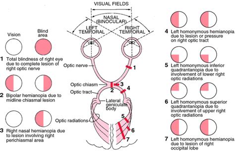 Hemianopsia: Definition, Causes, Solutions – Healthy Food Near Me