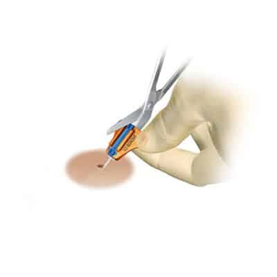 Placement & Removal Procedures - SecurAcath