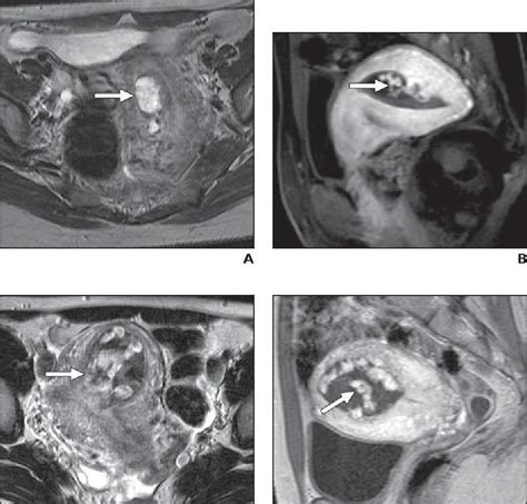 Figure 1—35 from CT and MRI of early intrauterine pregnancy. | Semantic Scholar