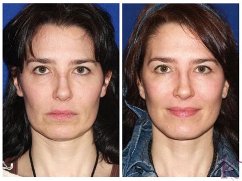 Mini Facelift in Manhattan, NYC | Konstantin Vasyukevich, MD