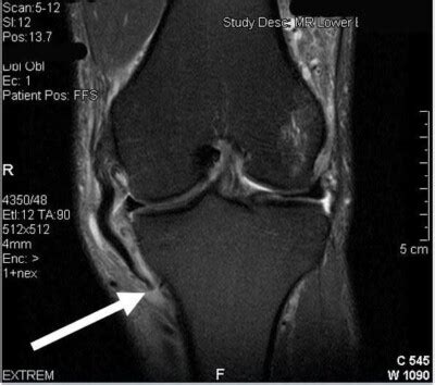 MCL Reconstruction | Medial Collateral Ligament Surgery | Minnesota