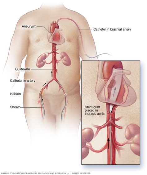 Endovascular repair for thoracic aortic aneurysm - Mayo Clinic