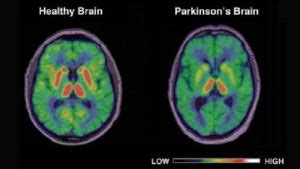 PARKINSON'S DISEASE: BIOMARKERS OF EARLY DISCOVERY - LifeSensors