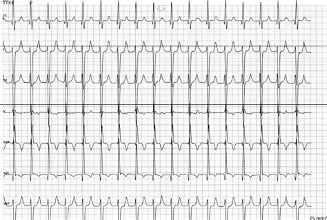 ECG Rhythms: Atrial Tachycardia is Easier to Catch in Telemetry Floors