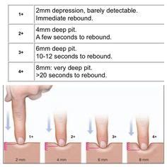 Edema Scale Diagram | Quizlet