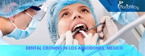 Dental Crown in Los Algodones Mexico - Mexico Border Dentist