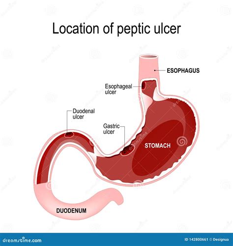 Location of peptic ulcer stock vector. Illustration of inflammation ...