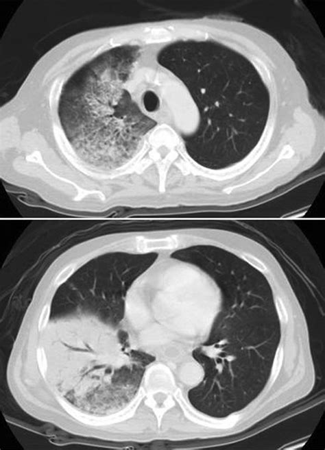 Pulmonary Bleb