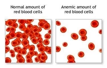 Anemia Red Blood Cells Image - Graph Diagram