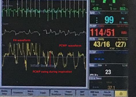 Utilizing CVP waveforms to assess the intensity of inspiratory efforts | LaptrinhX / News