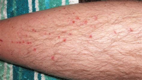 Pictures of Shingles Rash (part 2) | Shingles Expert