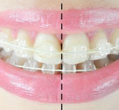 14 Radiance Plus Clear Sapphire Braces - Before and After ideas | ceramic braces, sapphire ...