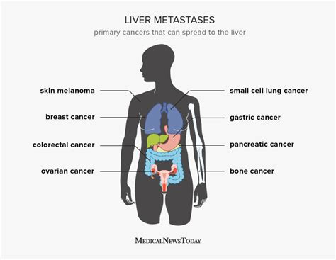 Liver metastases: Symptoms, diagnosis, and outlook