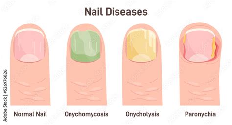 Onychomycosis, onycholysis, paronychia. Nail diseases, nail fungal เวกเตอร์สต็อก | Adobe Stock