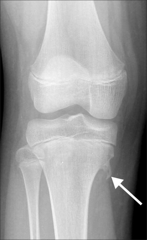 Osteochondroma is a benign tumor characterized by an ov | Open-i