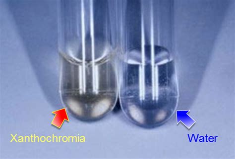 Cerebral Spinal Fluid (CSF) - Urinalysis and Body Fluids