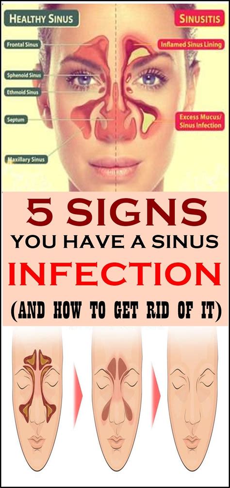 Signs And Symptoms Of Sinus Infection-prlog