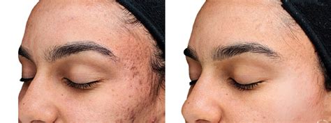 VI Peel Houston, TX | Chemical Peeling | Dr. Vitenas