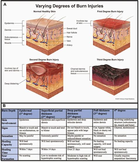 Burn Notice Blog Edition: Diagnosis/Classification of Burns