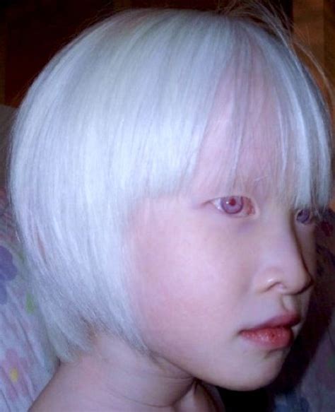 albinism in humans - pictures, photos