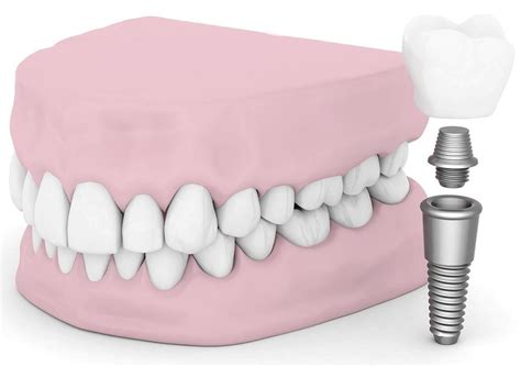 Affordable-Dental-Implants-in-Ipswich-Dentist-Ipswich