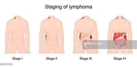 Hodgkin’s Lymphoma: Symptoms & Causes | NewYork-Presbyterian