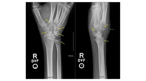 X-ray of right wrist showing interval progression of osteopenia and... | Download Scientific Diagram