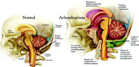 Cervicomedullary decompression for foramen magnum stenosis in ...