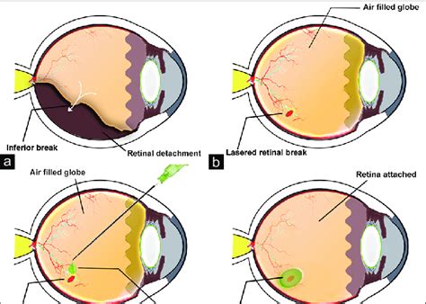 Schematic representation of the surgical technique of glue-assisted ...