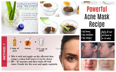 Top 3 Homemade Acne Remedies For Easy Acne Treatment