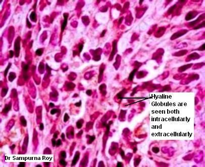 Kaposi's Sarcoma - Histopathology Image2 - Path Quiz Case 36 (Pathology ...