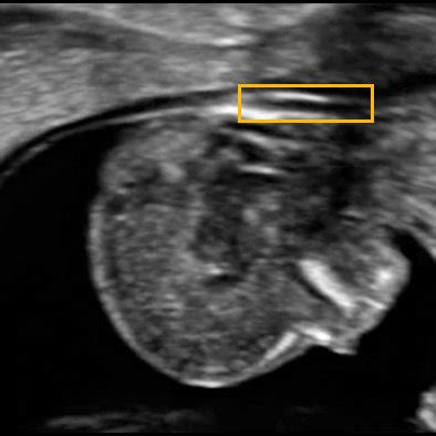 Sample ultrasound image with highlighted nuchal translucency ...